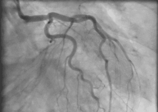 Coronary Disease Detection System