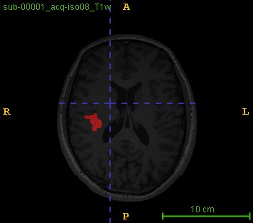 Epilepsy Detection System